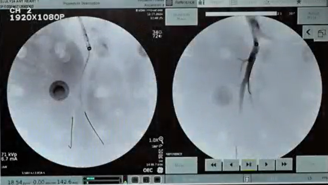 stent-delivery